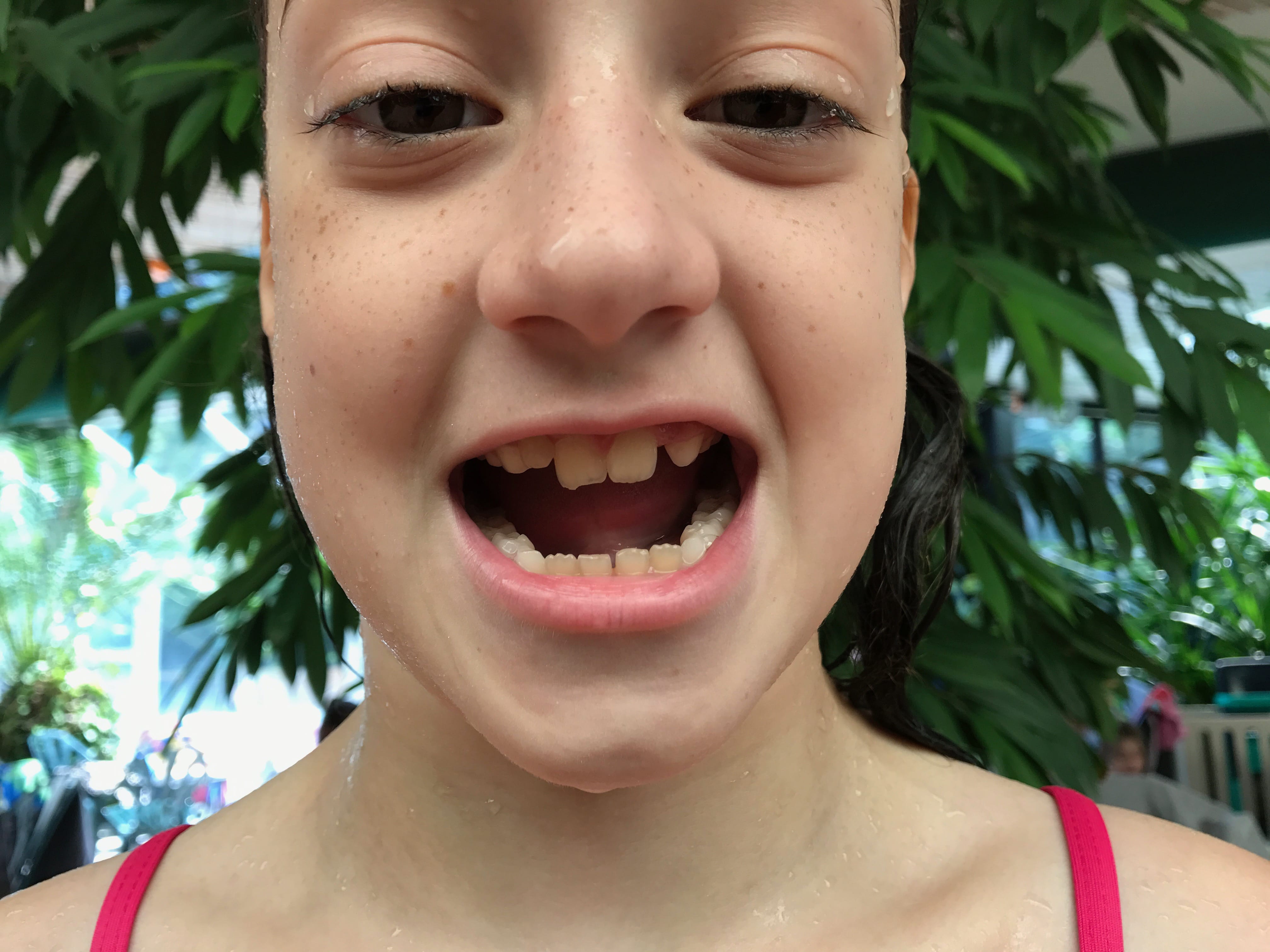 Isabella chipped her tooth